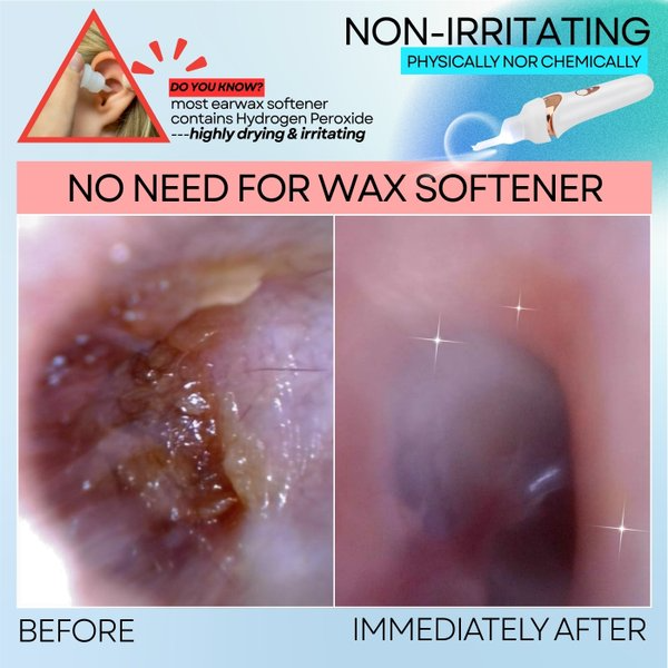 🔥Oferta especial🔥 Aspirador de cerumen: limpieza segura e indolora de los oídos para toda la familia.