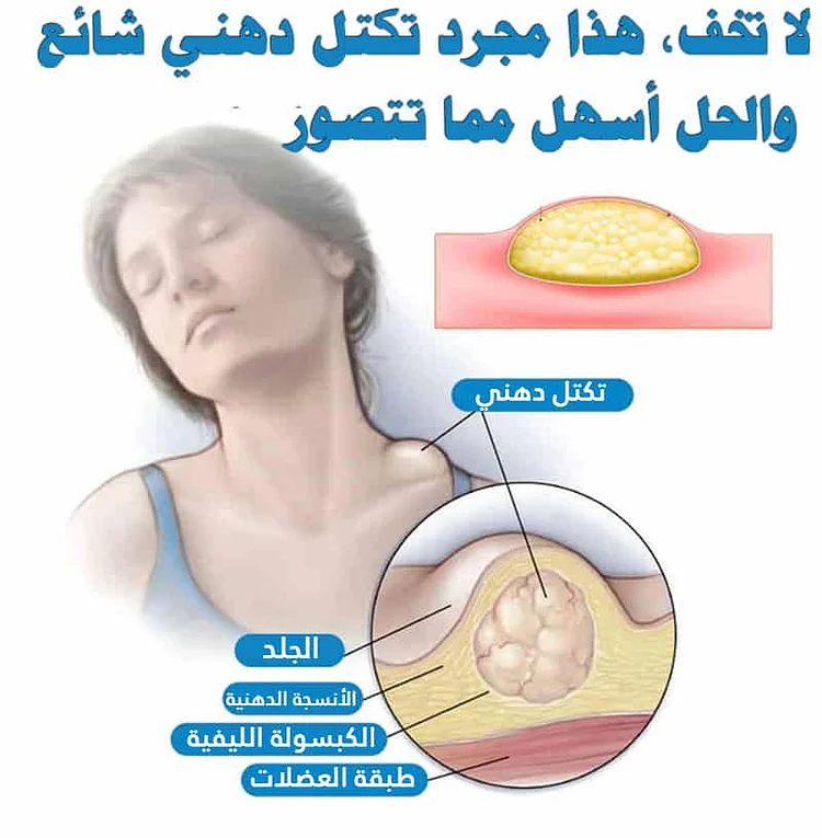 هل لاحظت كتلة ناعمةتحت الجلد تكبر ببطء؛ بدون ألم؟