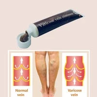 pornhint Pornhint Varicose Veins Treatment Cream Effective Cure Vasculitis...