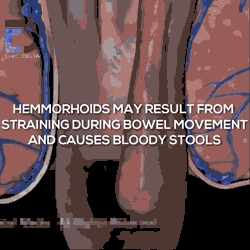 Hemorrhoids Cream