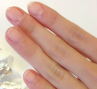 Rheumatoid Arthritis Nail Changes: Causes and Treatment | myRAteam