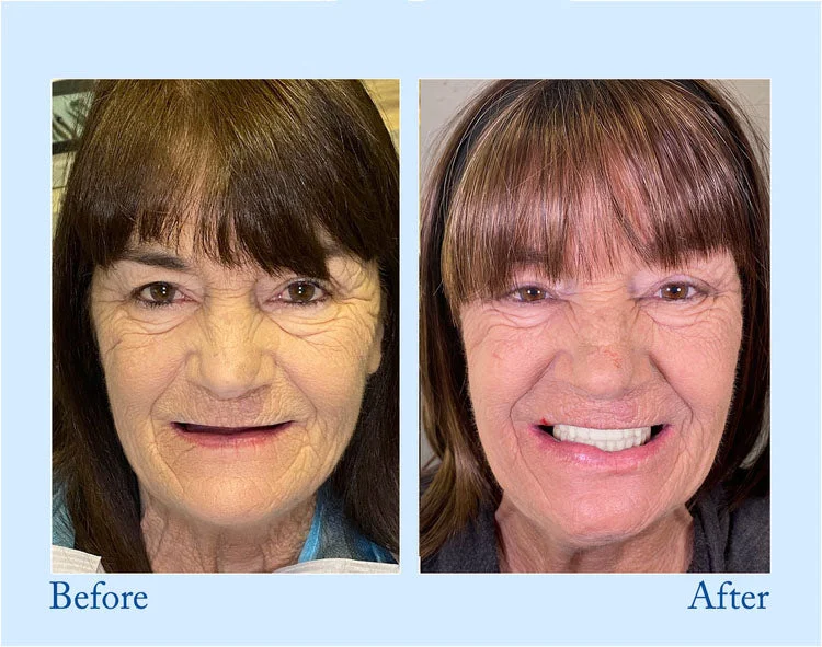 Smileasego - Premium Denture