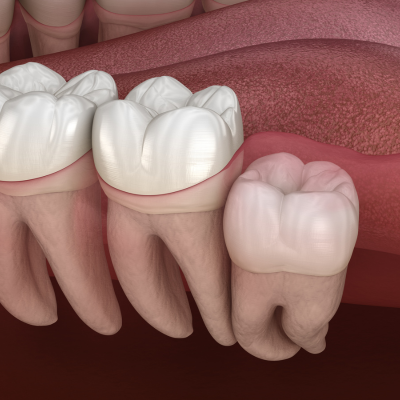 Wisdom Teeth