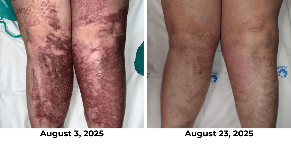 Official Store:LOVILDS® Magnesium Herbal Spray Fast Relief for Psoriasis & Eczema | No-Rub, SteroidFree