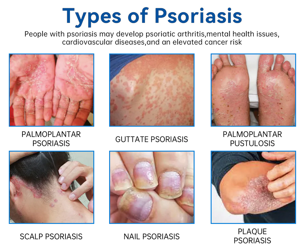 Official Store:LOVILDS® Magnesium Herbal Spray Fast Relief for Psoriasis & Eczema | No-Rub, SteroidFree