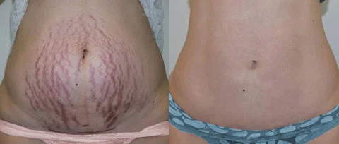 PISPARA™s Lymphatic Drainage & Shaping Powerful Lift Lace Bra