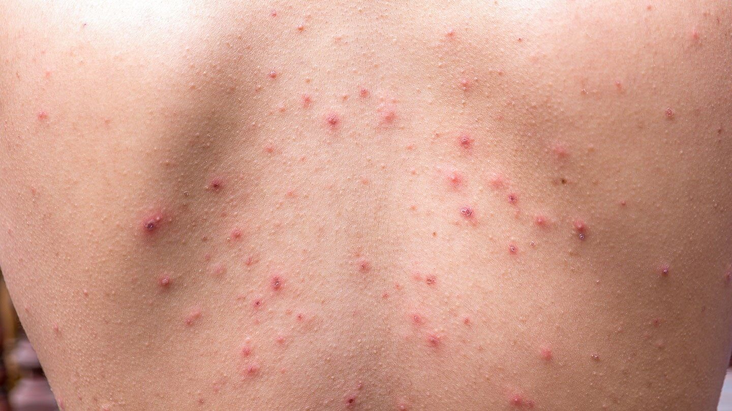 How to Prevent and Treat 8 Common Skin Conditions