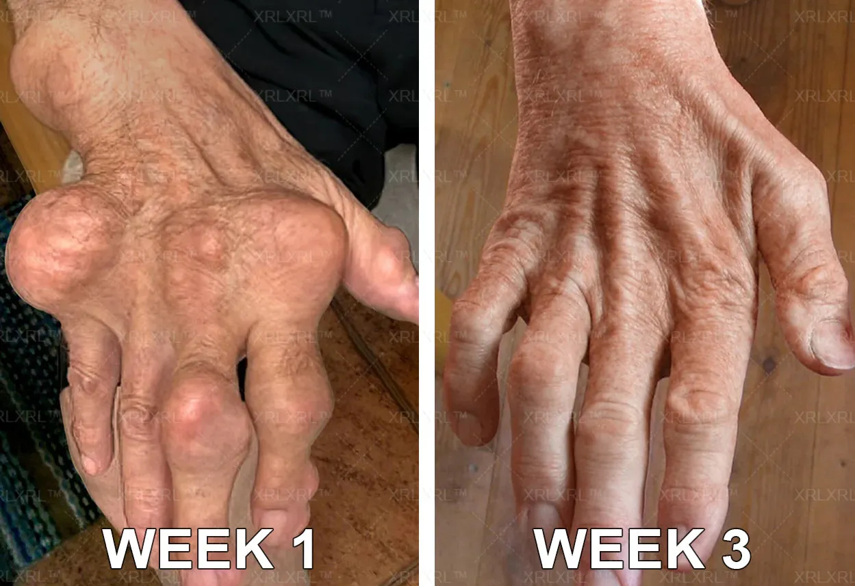Alcuras® Bee Venom Pain-Relief Bone Healing Cream 🇺🇸(Specially for older adults)