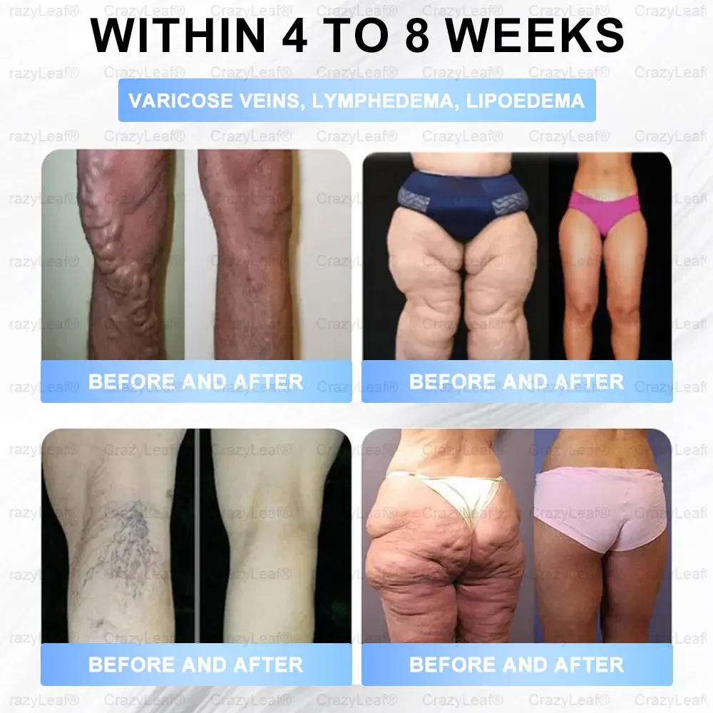 	Buildleaf&reg; Tirzepatide Nano Microneedle Patch with Collagen & Matrixyl 3000