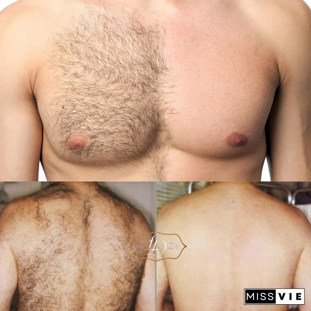 10ml/Permanent Hair Removal Spray Inhibiting and Reducing To Stop Hair Growth