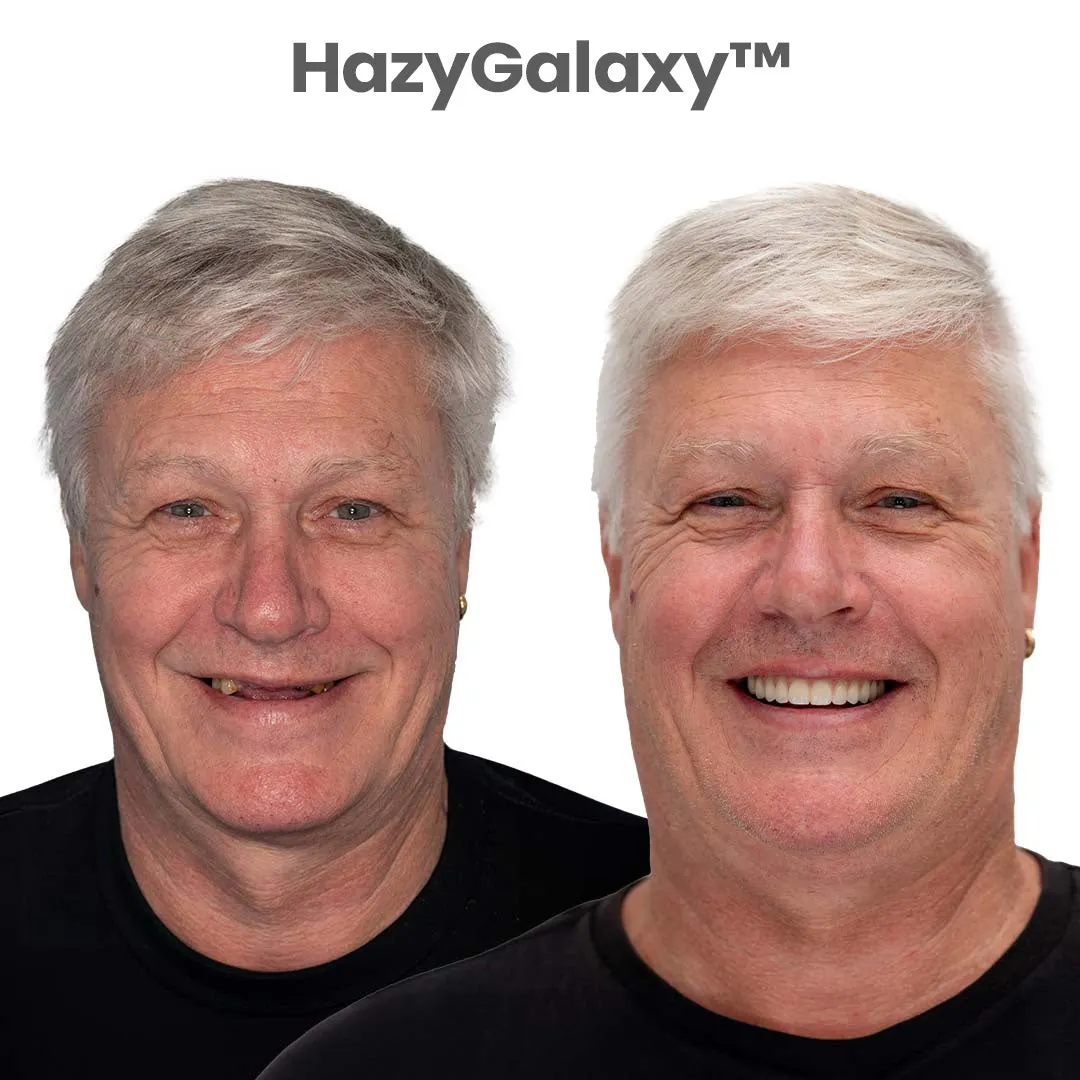 💥 ENDS TODAY 80% OFF🔥 HazyGalaxy&trade; Custom-Fit Dentures 🦷Smile with Confidence