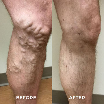 Oveallgo™ Varicose Veins Spray