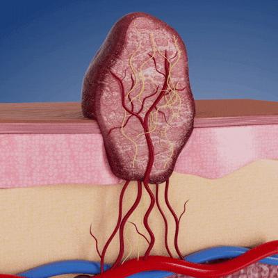 Yunpso™ MicroNeedle Botanic Skin Tag Removal Patch