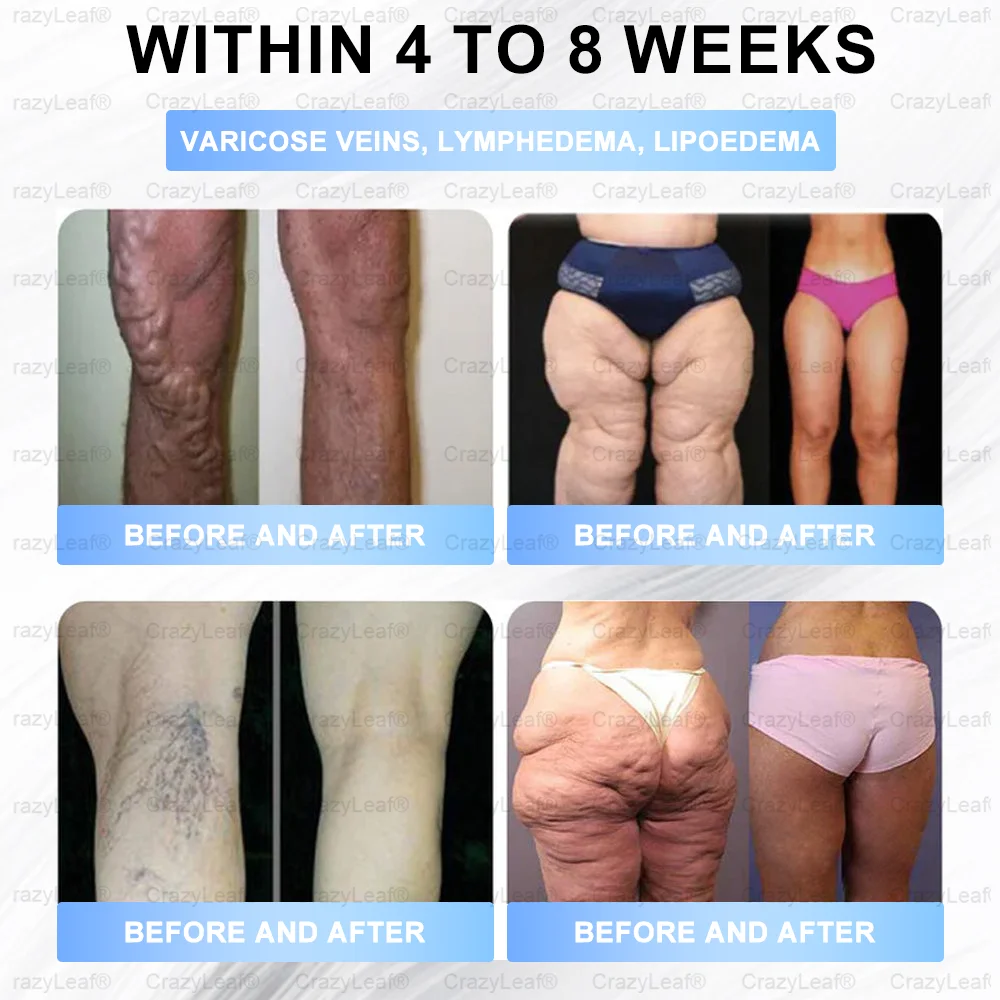 🏥FDA Store | 𝐵uil𝗱𝐿ea𝐟&reg; 𝑺𝑀𝗚T-𝑮𝐋𝑃-1 𝐒limming & 𝐻ealth 𝑁ano 𝑀icroneedle 𝑃atch with Collagen & Matrixyl 3000 丨Obesity,Cardiovascular Diseas, Diabetes, Sleep Apnea, Joint Problems and More