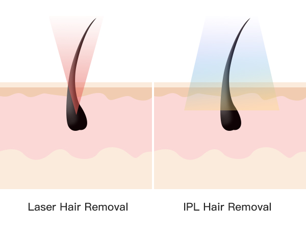 Laser Hair Removal