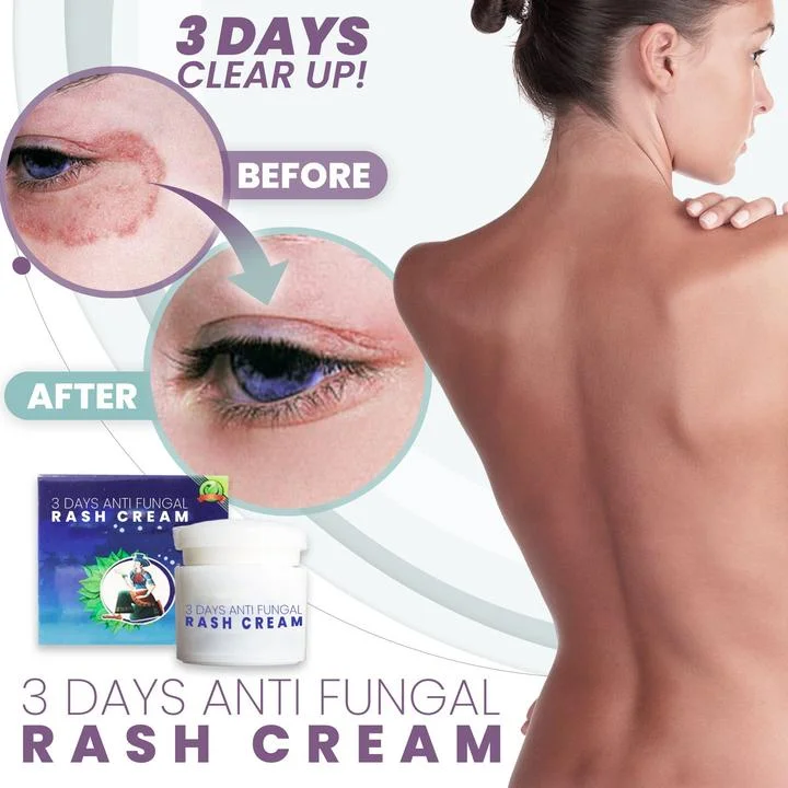 3 Days Anti Fungal Rash Cream