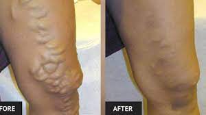 Varicose vein fix: Glue leaky leg valves