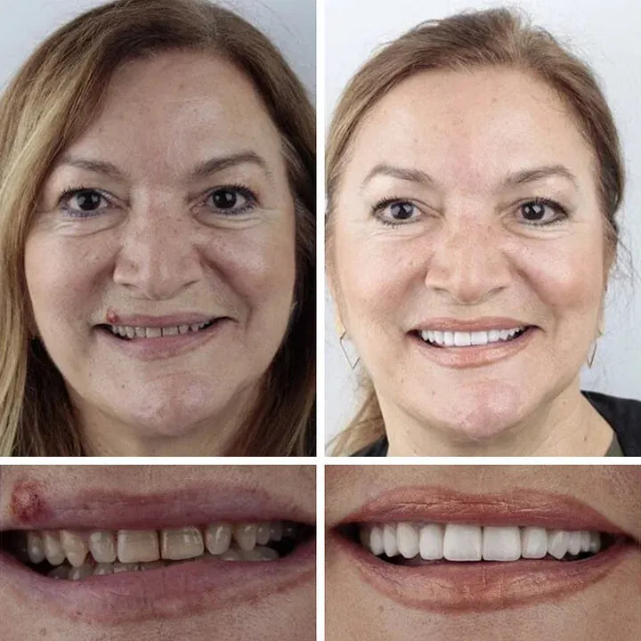 Ends Today: 70% OFF! ⏰ Medical Full Denture with Strong Suctiond🦷Obtain American Dental Association (ADA) Certification
