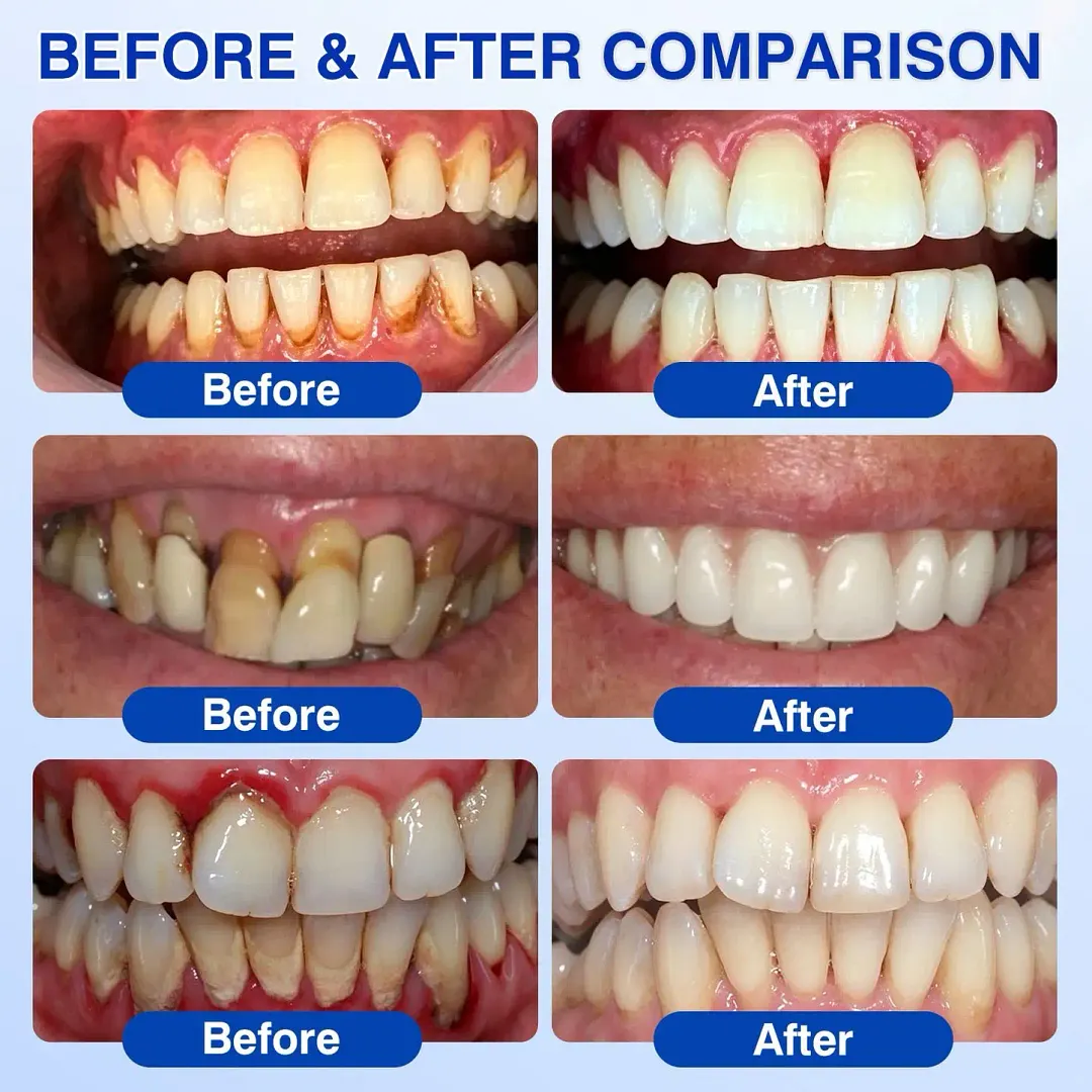 𝐆𝐮𝐦𝐑𝐞𝐯𝐢𝐯𝐞 Periodontal Repair Gel