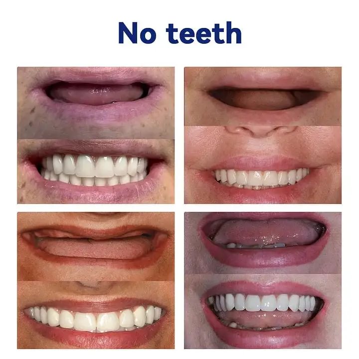 	Bikenda&trade;-🦷Advanced Customized Full Denture Set