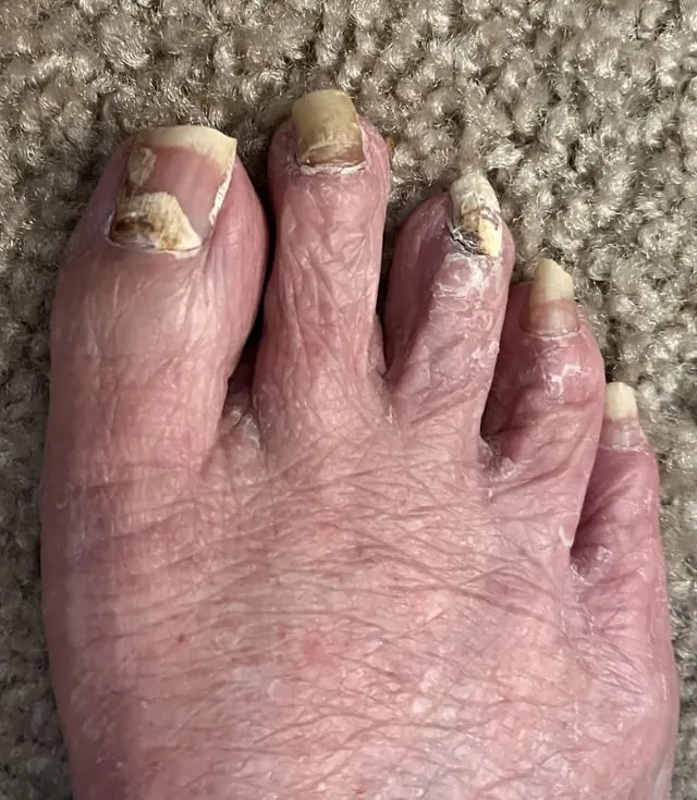 r/NailFungus - ¿Esto es un hongo?