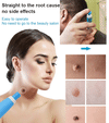 💥Double-head Wart Removal Tool - Remove your skin tags painlessly at home