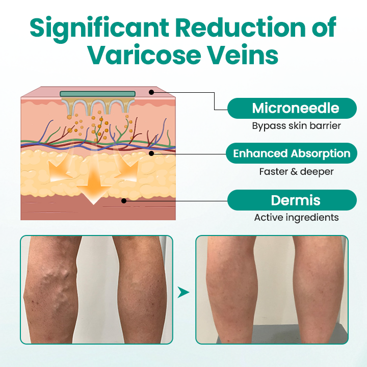 LegRenew Varicose Veins Patch