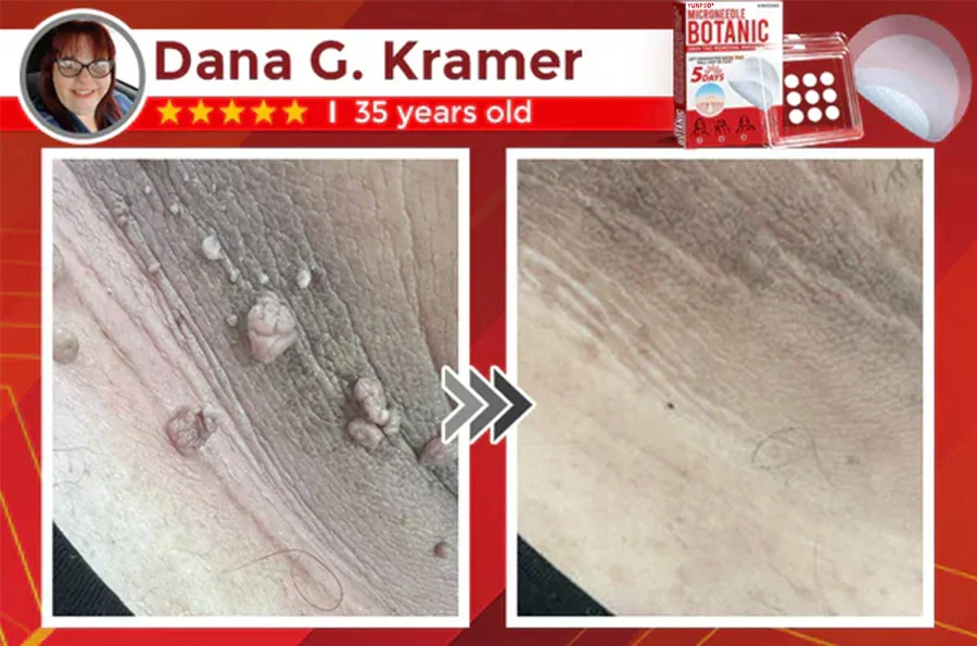 Yunpso™ MicroNeedle Botanic Skin Tag Removal Patch