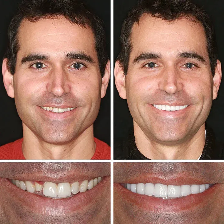 Ends Today: 70% OFF! ⏰ Medical Full Denture with Strong Suctiond🦷Obtain American Dental Association (ADA) Certification