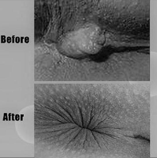 Hemorrhoids Cream