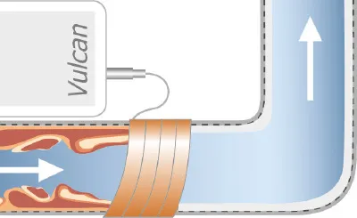Cleans existing buildup diagram