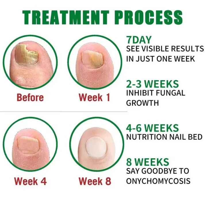 Last Day 50% OFF💕Ginger Nail Care Oil