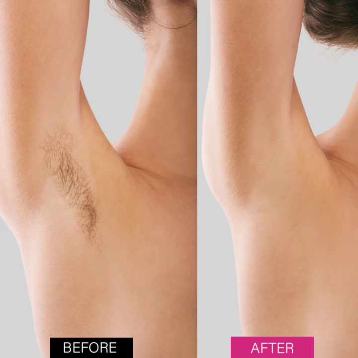 Last Day 49% OFF🔥Hair Removal Mousse