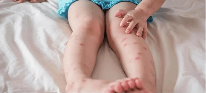 BuzzBGone - Prevent Mosquito Bites