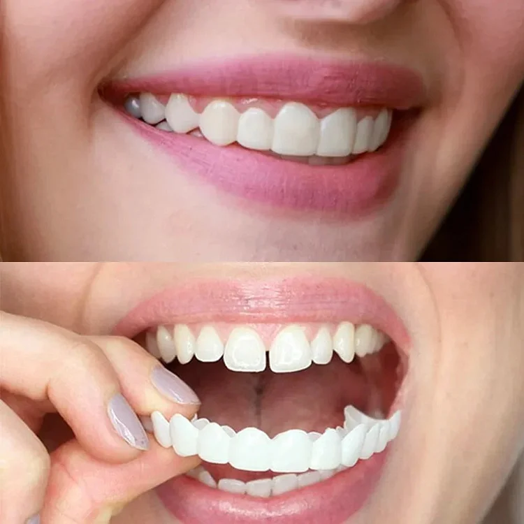 Smile Veneers (Upper & Lower)