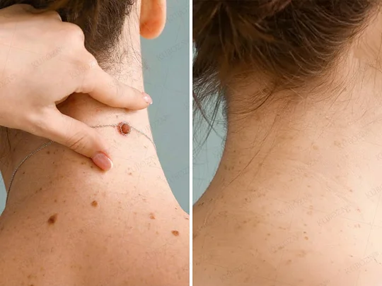 Dobshow® Wart and mole removal microneedle patch