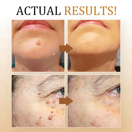 🐝🐝Bee Venom Mole and Wart Treatment Cream