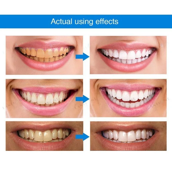LAST DAY 49%OFF - Teeth Whitening Pens