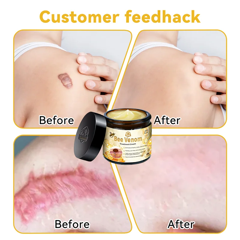 🐝𝑇𝑢𝑟𝑜𝑛𝑢 Bee Venom Skin Treatment Cream𝐴𝐴𝐷 𝑅𝑒𝑐𝑜𝑚𝑚𝑒𝑛𝑑𝑒𝑑