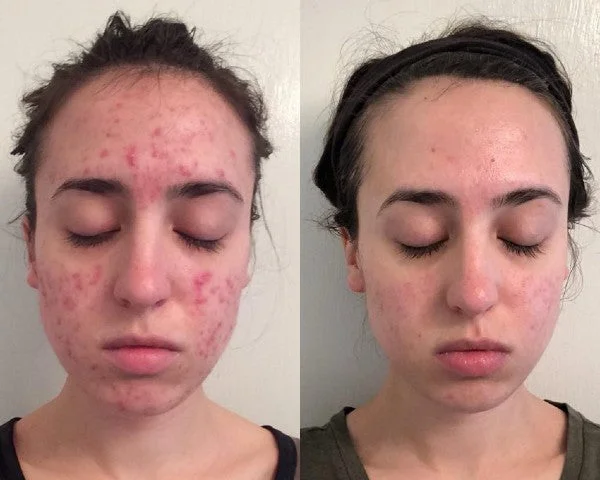 NESLEMY™ Advanced Scar Gel