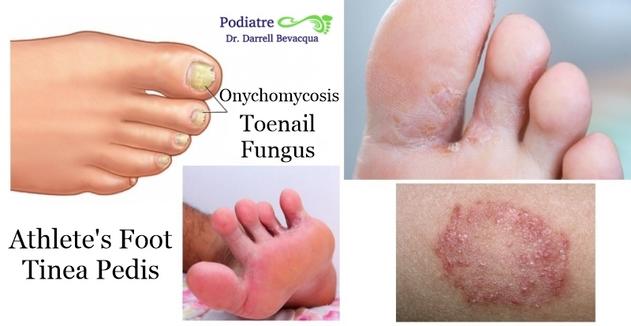 Athletes foot (Tinea pedis) Consult us for all fungal problems of the feet.