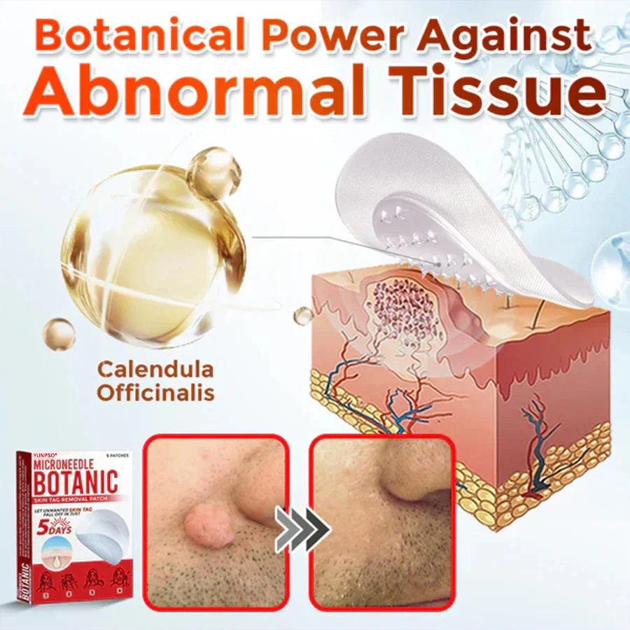 Yunpso™ MicroNeedle Botanic Skin Tag Removal Patch