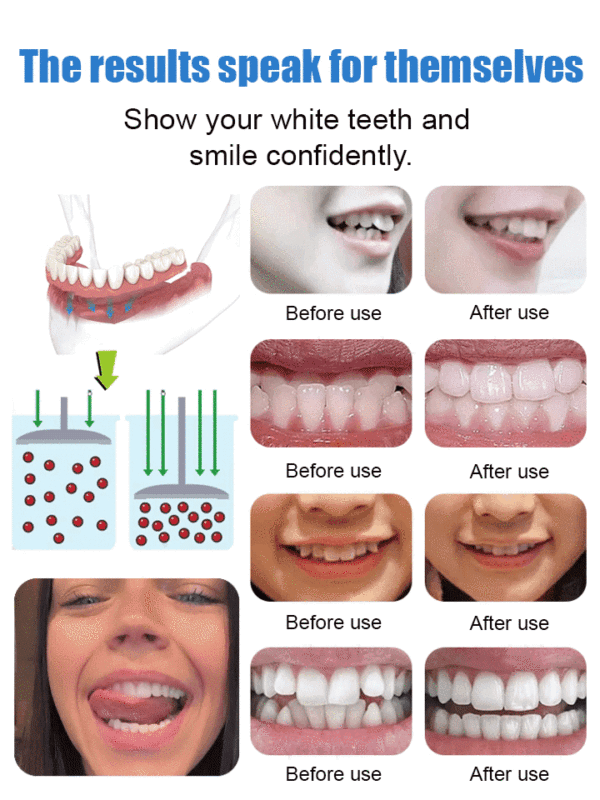 Functional complete denture restoration kit
