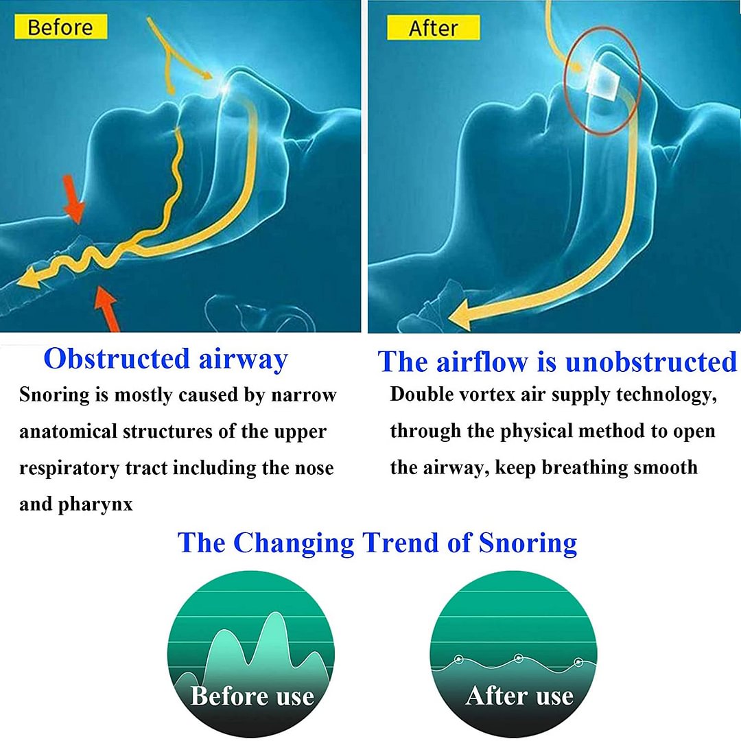 Airing: the first hoseless, maskless, micro-CPAP 🔥BUY 2PCS + GET 1 FREE ...