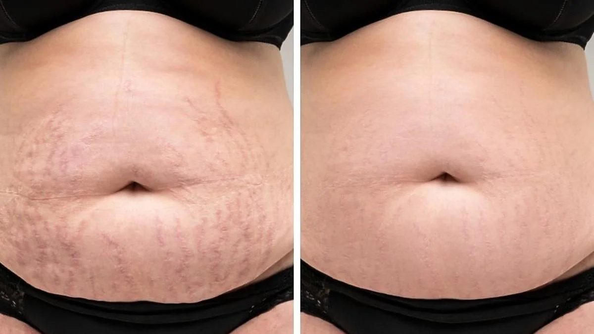 NESLEMY™ Advanced Scar Gel