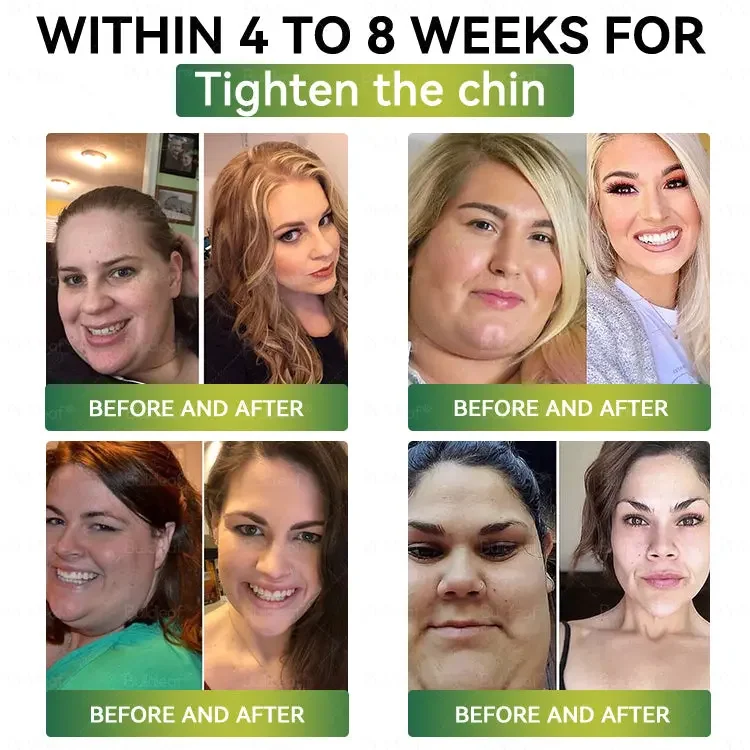 	Buildleaf&reg; SMGT-GLP-1 Nano Microneedle Patch with Collagen Peptides &Matrixyl 3000