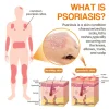 🔥Hot Sale 49% Off🔥PsoriaHeal psoriasis Spray