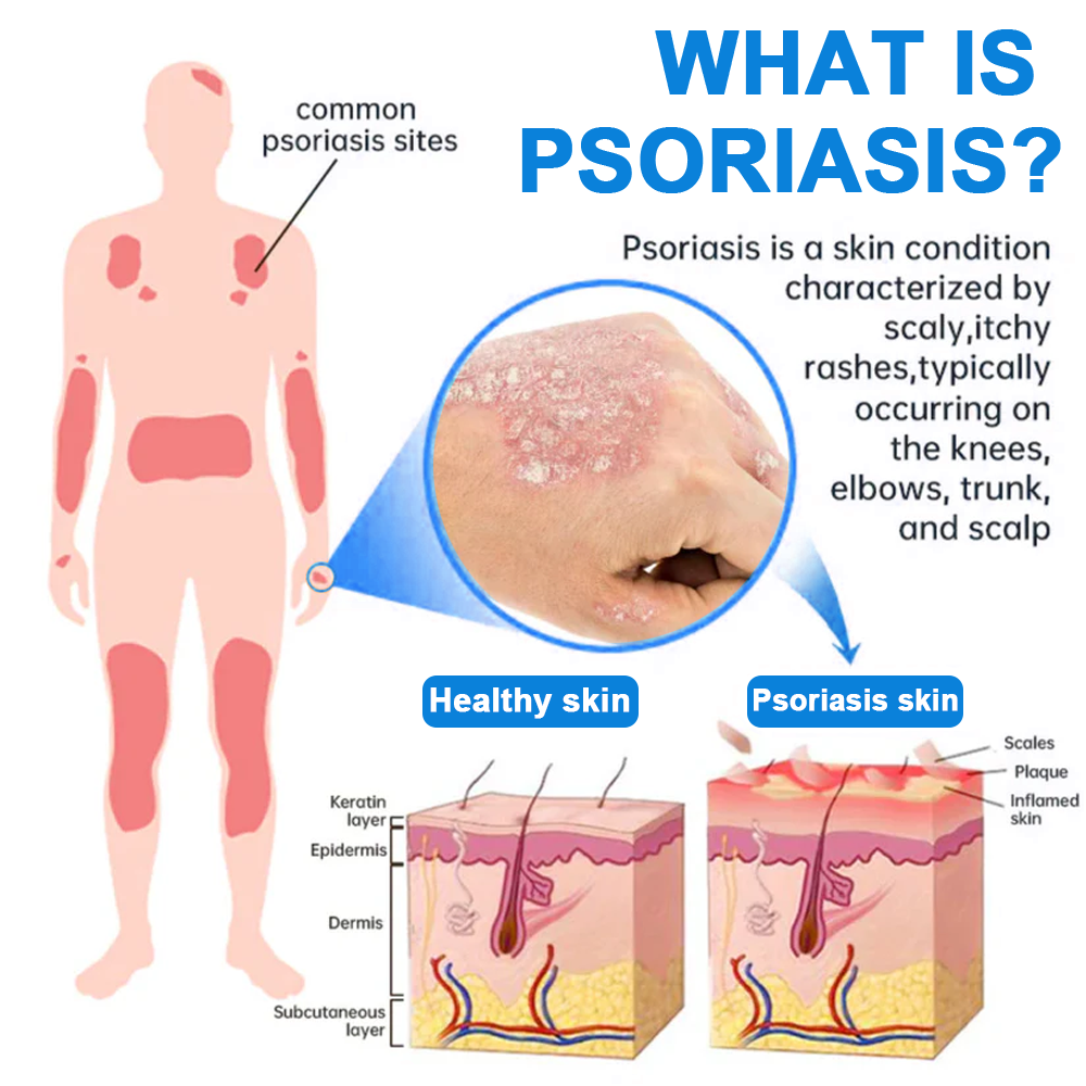 Official Store:LOVILDS® Magnesium Herbal Spray Fast Relief for Psoriasis & Eczema | No-Rub, SteroidFree