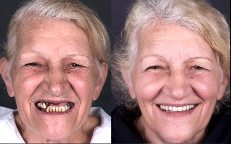 🔥Ends Today: 70% OFF!(Affordable Beauty🧏‍♀️🧏‍♂️)--ROSOPL™ --Advanced Customized Full Denture Set🦷