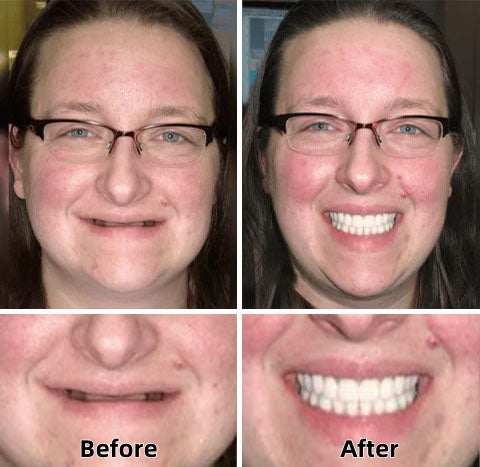 Natravor™-Advanced Custom-Fit Functional Dentures